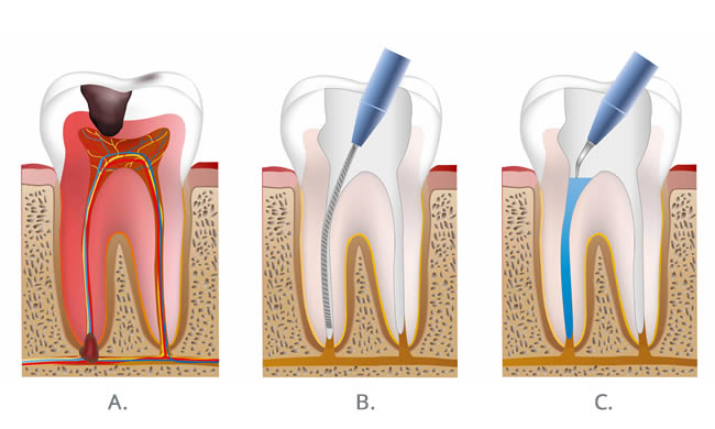 root canal graphic
